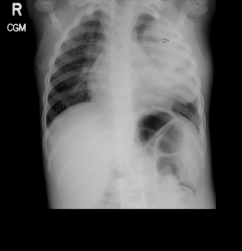 CXR with LUL Pneumonia and lung abscess.png