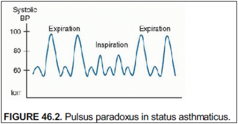 figure-46.2-pulsus-paradoxus-in-status-asthmaticus.png