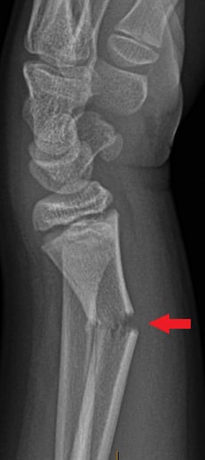 Side-view (lateral) x-ray of the left wrist. The red arrow shows a transverse fracture of the arm bone near the wrist (distal radius). A transverse fracture is when the bone breaks straight across.