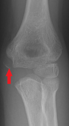 Front-view (anteroposterior) x-ray of the left elbow. The red arrow shows a fracture of the end of the upper arm bone at the elbow (avulsion fracture of the medial epicondyle of the humerus). An avulsion fracture occurs when a tendon or ligament pulls too hard on the bone and breaks off a small piece.