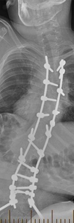 X-ray of posteroanterior view of Shilla growing rods