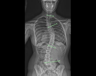 X-ray of curved spine before ApiFix placement