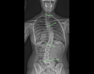 Bracing Options for Scoliosis