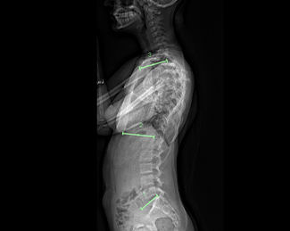 X-ray of spine before Zimmer Tether placement (lateral view)