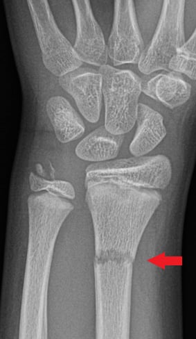 Front-view (anteroposterior) x-ray of the left wrist. The red arrow shows a transverse fracture of the arm bone near the wrist (distal radius). There is also a fracture in the other arm bone at the wrist (ulna styloid fracture). A transverse fracture is when the bone breaks straight across.