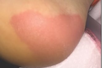 Photo of redness on a person's heel.