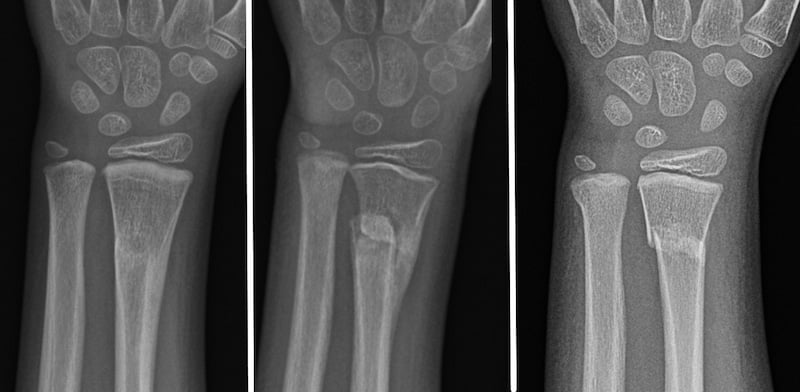 Front-view (anteroposterior) x-rays of the left wrist. The images from right to left show the bone healing (remodeling) process of a fracture of the arm bone near the wrist (displaced distal radius fracture).