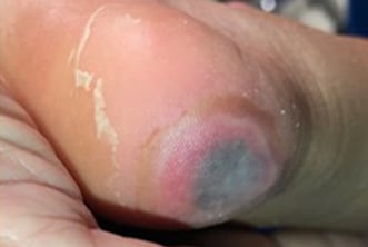 Photo of bruising on a person's heel.