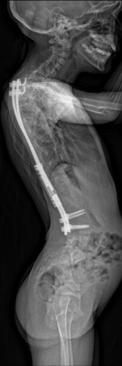 X-ray of ateral view of growing rods