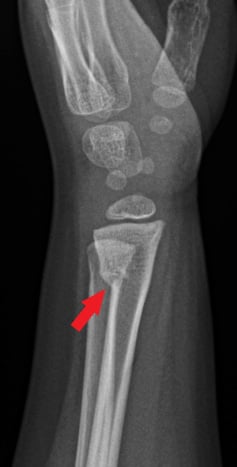 Side-view (lateral) x-ray of the left wrist. The red arrow shows a fracture in the arm bone near the wrist (distal radius fracture).  There is also a fracture near the wrist in the ulna, the other bone in the forearm.