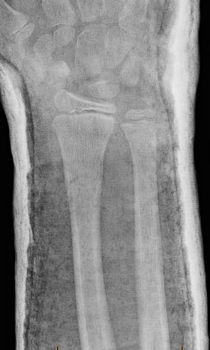 Front-view (anteroposterior) x-ray of the right wrist. The images show the repair over time (interval reduction) of the fracture of the forearm near the wrist (distal radius fracture).