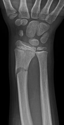 Front-view (anteroposterior) x-ray of the right wrist. The image shows a fracture of the forearm near the wrist (displaced distal radius fracture) before it is realigned (prereduction).
