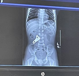 X-ray of magnets in Elijah's digestive tract.