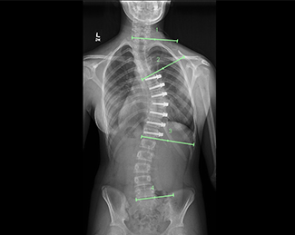 X-ray of spine after Zimmer Tether placement  (posteroanterior view)
