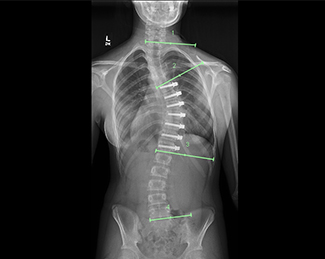 X-ray of spine after Zimmer Tether placement (posteroanterior view)