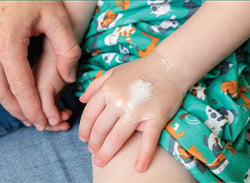 Lidocaine numbing cream applied to a child's hand.