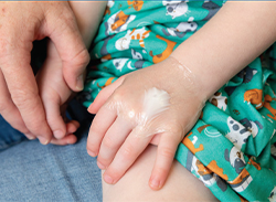 Crema anestésica de lidocaína aplicada en la mano de un niño.