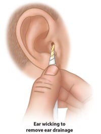 A small piece of rolled tissue is inserted into the ear canal to remove drainage