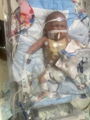 A newborn baby lies in a hospital bed with a tube in her mouth and many other wires and tubes around her body.