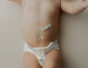 G-tube in infant's stomach for feeding.