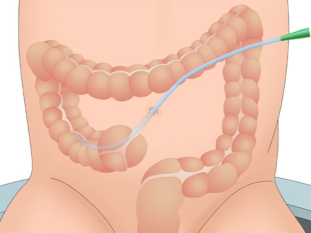 An illustration of a catheter further entering the stoma  and colon of a child.