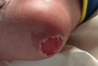 Photo of blisters on a person's heel.