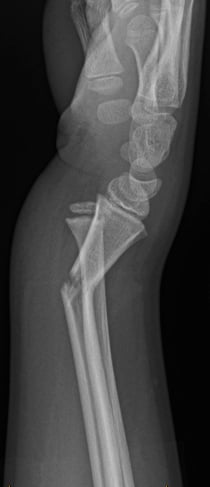 Side-view (lateral) x-ray of the right wrist. The image shows a fracture of the forearm near the wrist (displaced distal radius fracture) before it is realigned (prereduction).