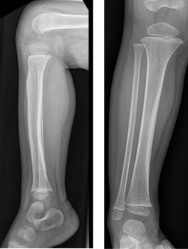 Two X-rays showing different views of a broken ankle.