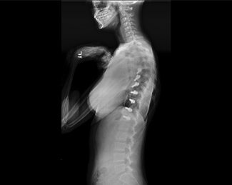 X-ray of spine after Zimmer Tether placement  (lateral view)