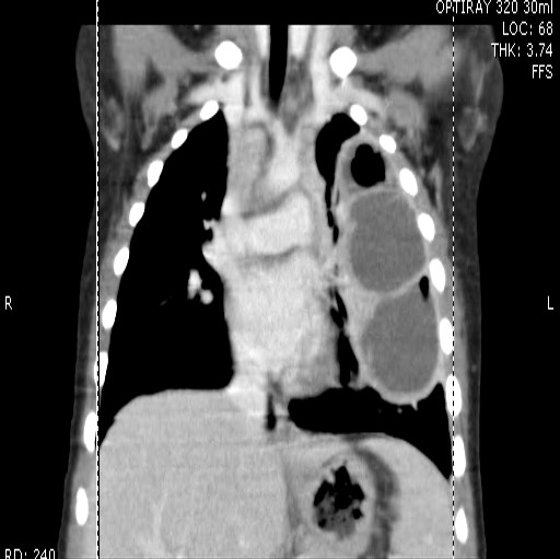 CT of lung abscess.jpg