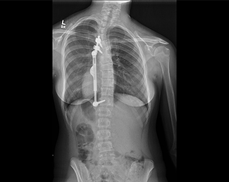 X-ray of spine after ApiFix placement