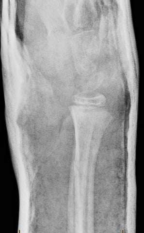 Side-view (lateral) x-ray of the right wrist. The images show the repair over time (interval reduction) of the fracture of the forearm near the wrist (distal radius fracture).