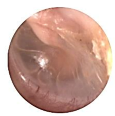 Otitis Media with Effusion