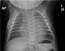Chest xray Oct 2022.png