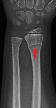 Front-view (anteroposterior) x-ray of the left wrist. The red arrow shows a fracture in the arm bone near the wrist (distal radius fracture).  There is also a fracture near the wrist in the ulna, the other bone in the forearm.