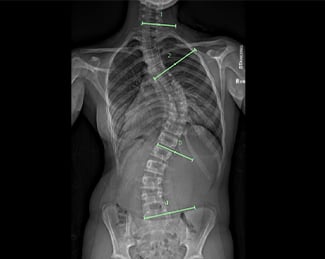 X-ray of spine before Zimmer Tether placement  (posteroanterior view)