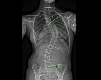 Bracing Options for Scoliosis