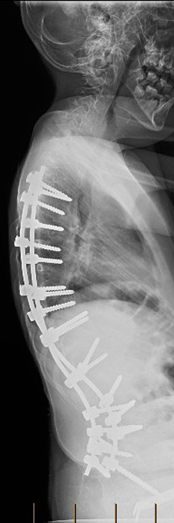 X-ray of lateral view of Shilla growing rods