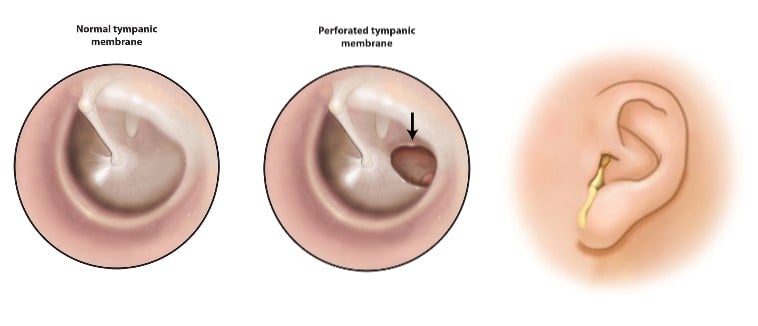 Illustrations showing a normal tympanic membrane, a perforated  tympanic membrane and yellow drainage coming out of an ear.