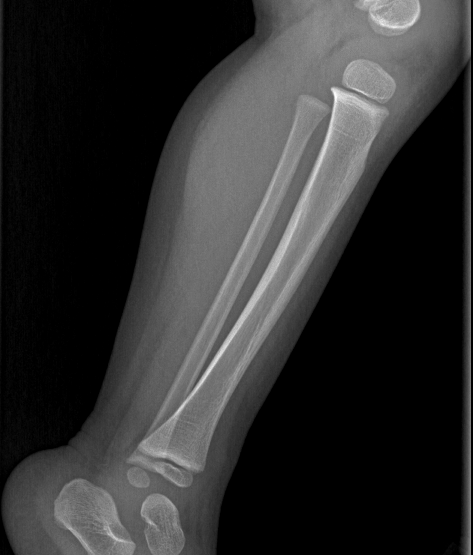 Toddler Tibia Fracture Childrens Mercy Kansas City