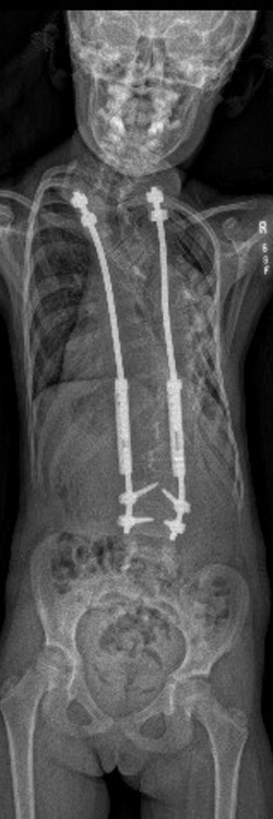 X-ray of posteroanterior view of growing rods