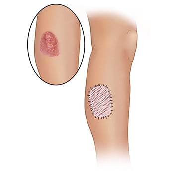 Illustration of a leg with burn and another illustration with the burn covered with a skin graft.