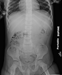 XR Abdomen.jpg