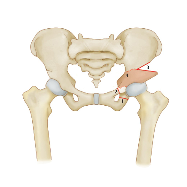 Illustration of a pelvis with left hip dysplasia after surgery