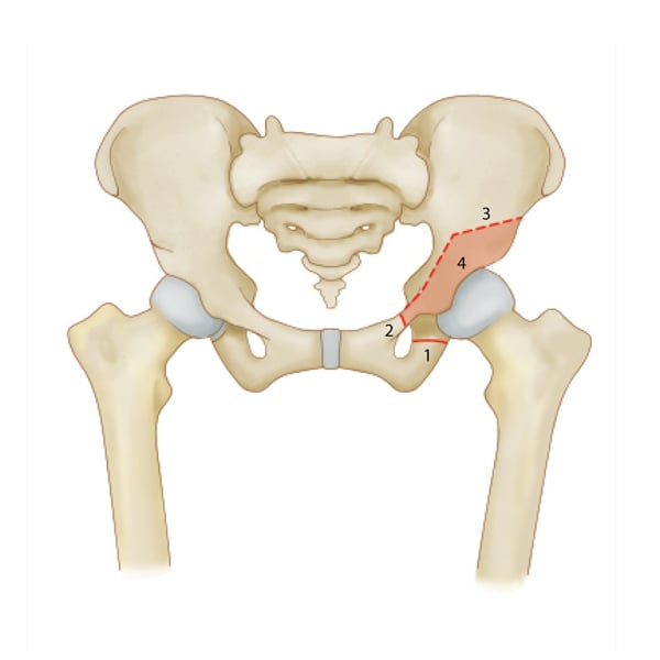 Illustration of a pelvis with left hip dysplasia before surgery
