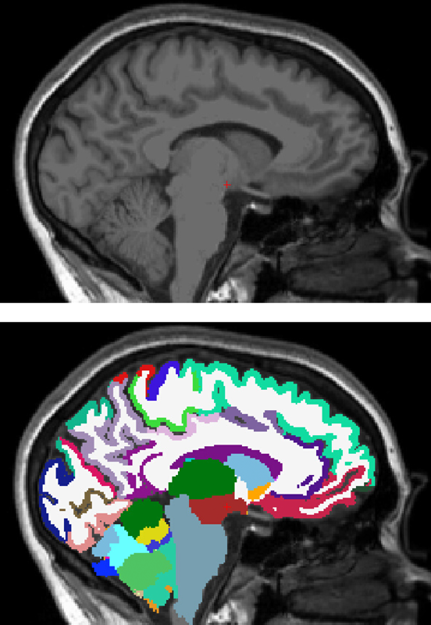 Top: T1 MRI: structural brain MRI scan widely used in both clinical and research field. Bottom: Segmentation: cerebral and cerebellar regions (colored) from T1. 