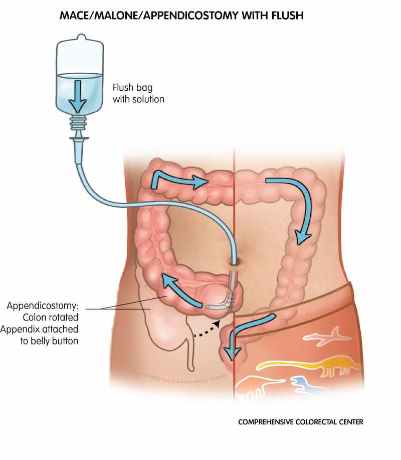 An appendicostomy is a surgery that allows a child to receive an enema through their bully button or abdomen directly into the beginning part of the colon. The surgery is also known as an antegrade colonic enema, appendicostomy, a Malone procedure, or MACE.