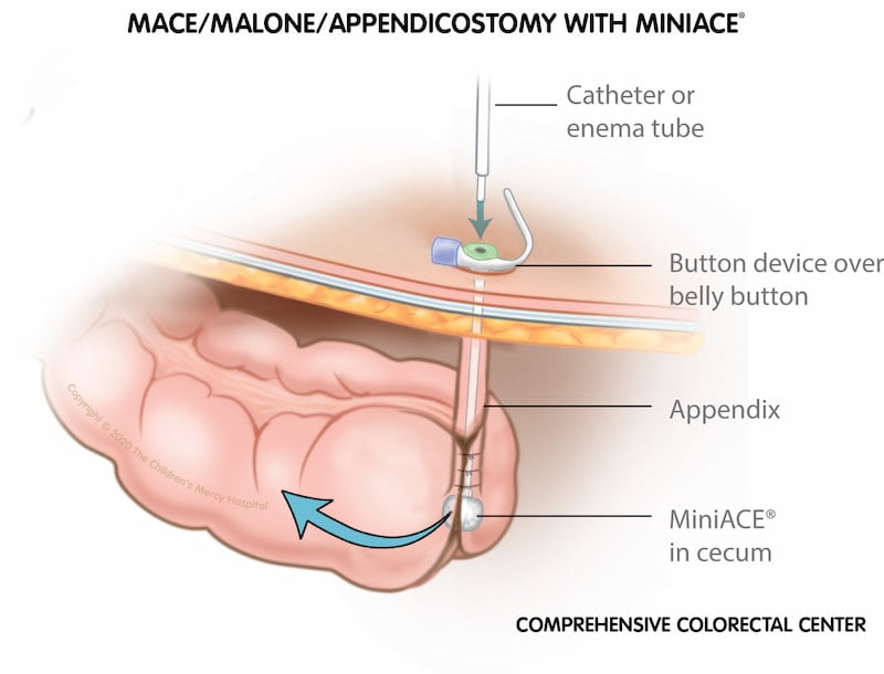 The MiniACE® device can be added during appendicostomy or cecostomy surgery. This device makes it easier to find the hole to perform the enema.