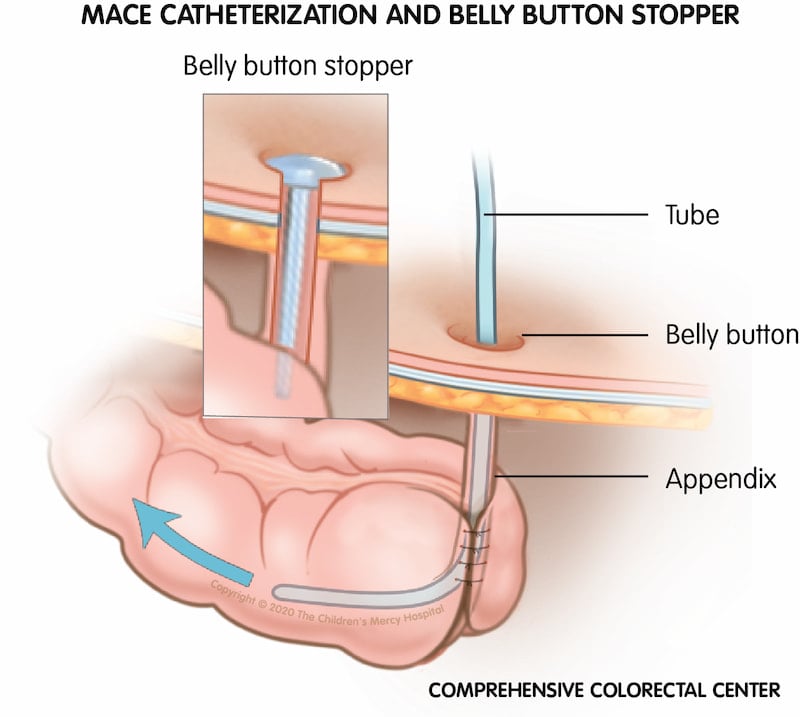 The tube, or catheter, that is inserted during surgery will stay in place for the first month. Then, the temporary tube is removed and a button stopper is temporarily inserted between times of flushes to help keep the skin around the newly created hole from closing.