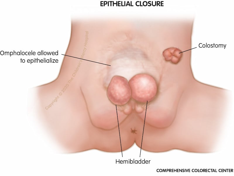Epithelial closure happens when skin and scar tissue grows over the omphalocele. This is an option when the omphalocele has too many organs within it to bring normal skin across.